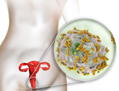 ŠTA JE BAKTERIJSKA VAGINOZA?